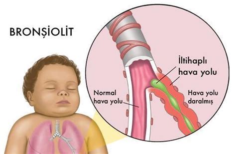 6 aylık bebeklerde bronşit nasıl geçer